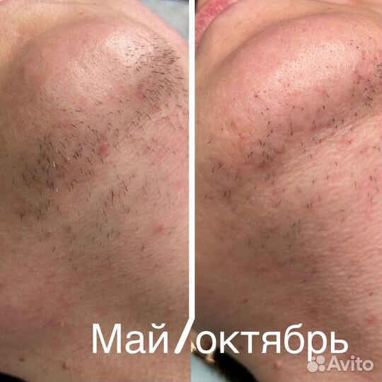 Электроэпиляция