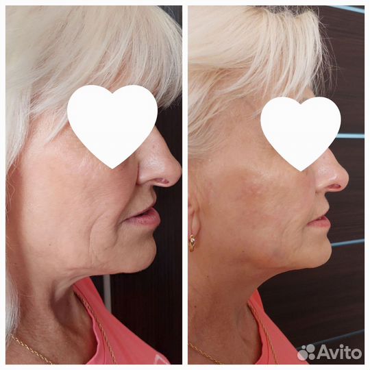 Смас лифтинг тела