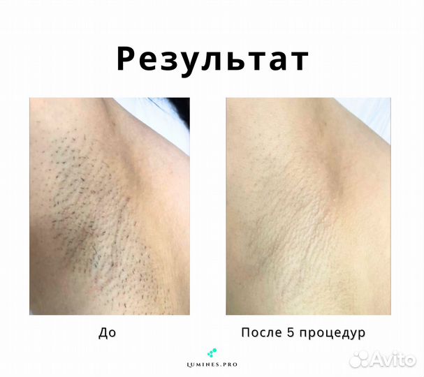 Аппарат для эпиляции «Lumines» максван 1200в