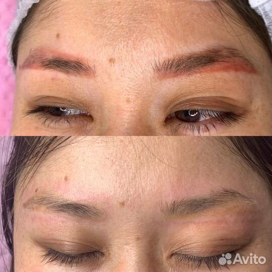 Удаление татуажа лазером