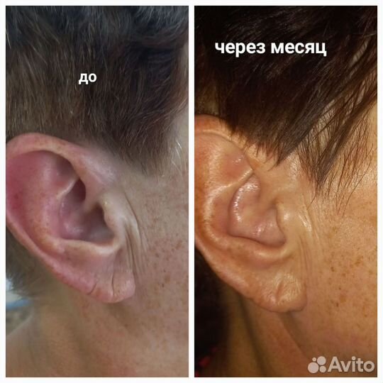 Омоложение лица