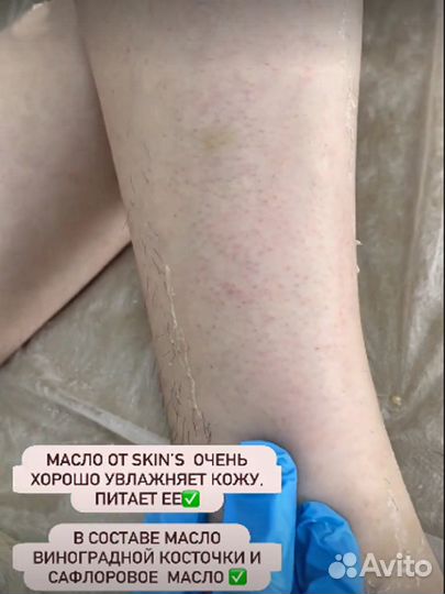 Депиляция волос Инновационным методом