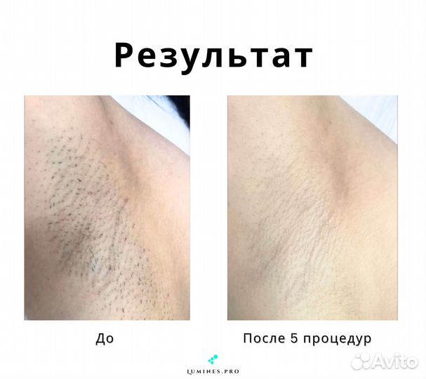 Аппарат для эпиляции lumines Макс Ван 1200 Вт