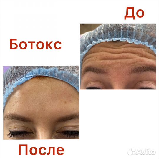 Ботокс для лица