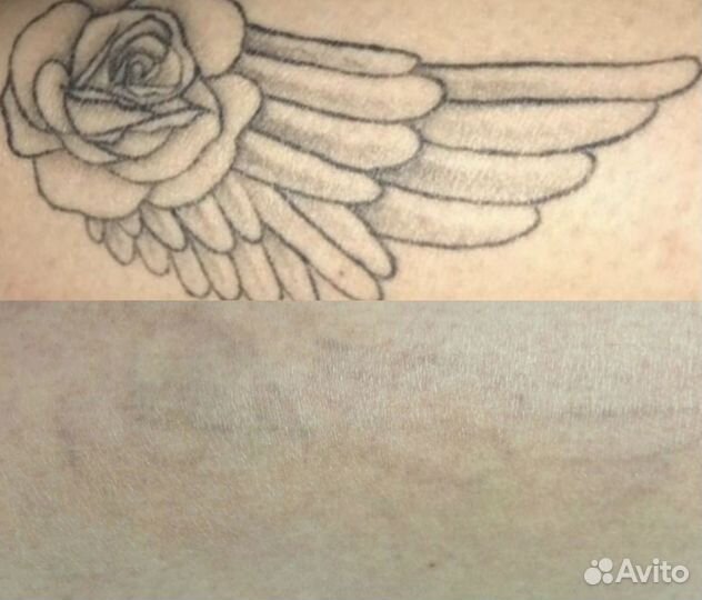 Лазерное удаление татуажа и тату, и ремувером