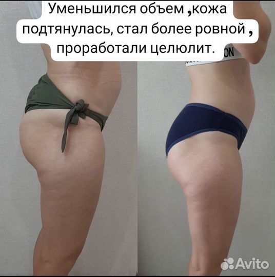 Кавитация, вакум, лазерный липолиз, рф-лифтинг