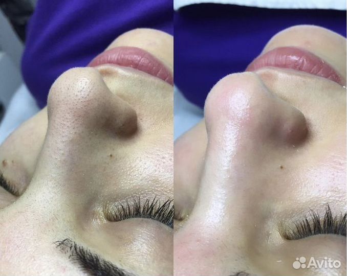 Чистка лица модель