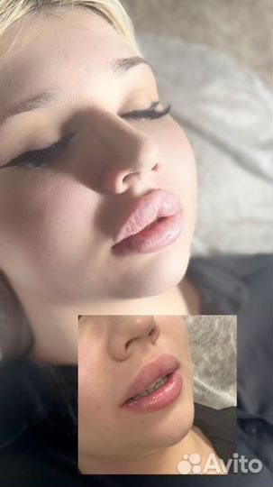 Увеличение губ Скидка 50%