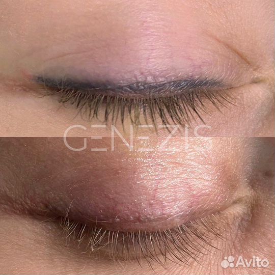 Удаление/осветление тату и татуажа лазером