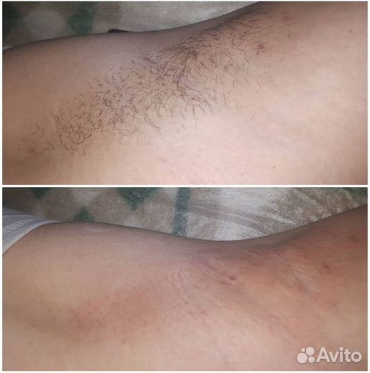 Шугаринг, удаление волос сахарной пастой