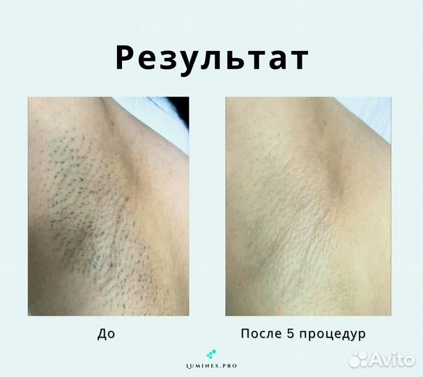 Аппарат для эпиляции Lumines’ Макс Ван 1200в