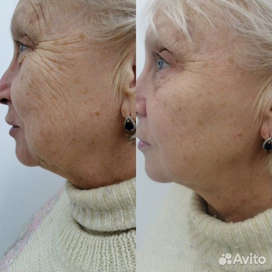 Смас лифтинг лица