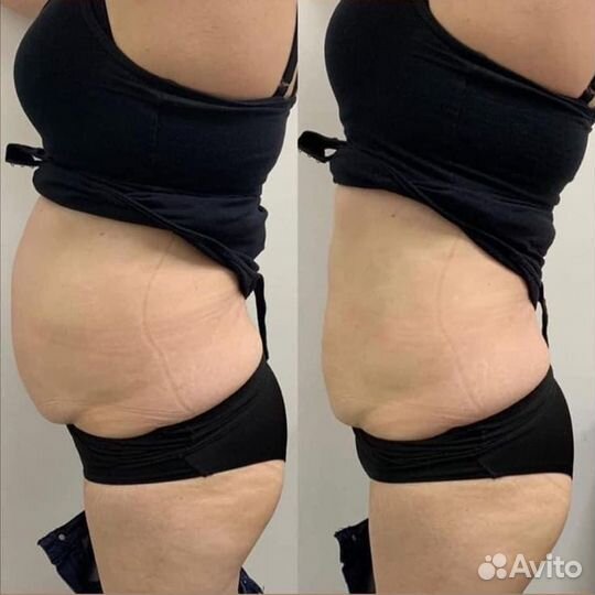 LPG-массаж, вибро - массаж, рф-лифтинг