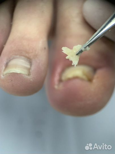 Педикюр, подолог, вросший ноготь