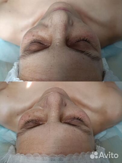 УЗ чистка лица (9 этапов )