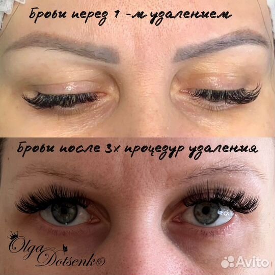 Удаление татуажа