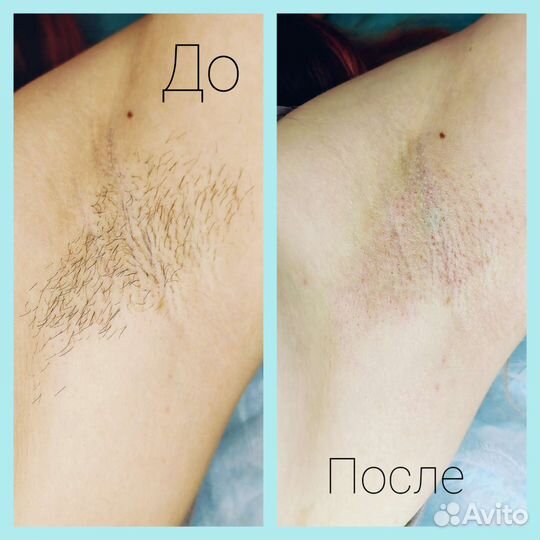 Депиляция воском