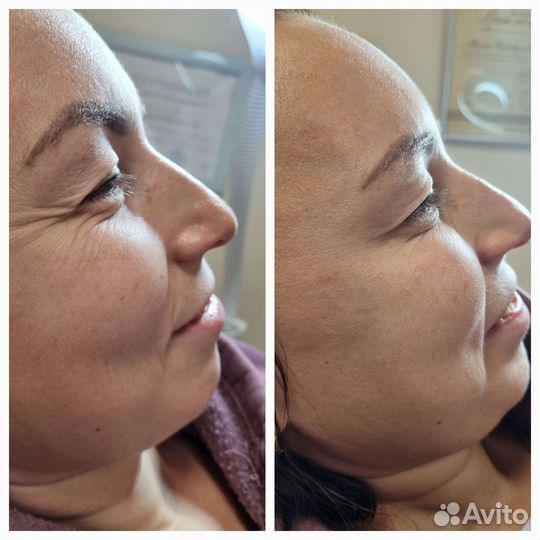 Инъекции ботокса в лоб