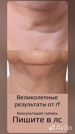 Микроигольчатый RF лифтинг