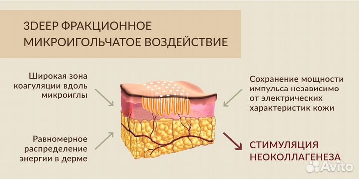 Игольчатый РФ лифтинг