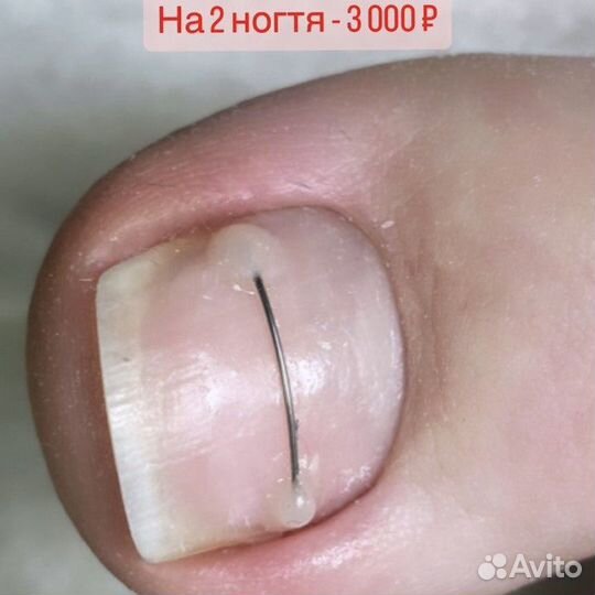 Медецинский педикюр.подолог.для мужчин И женщин