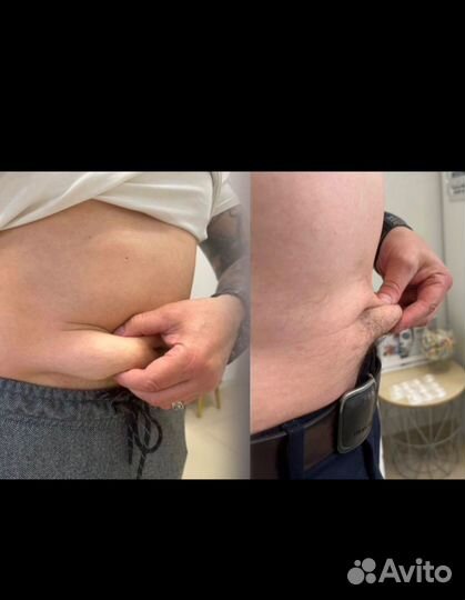 Похудение липолитиками