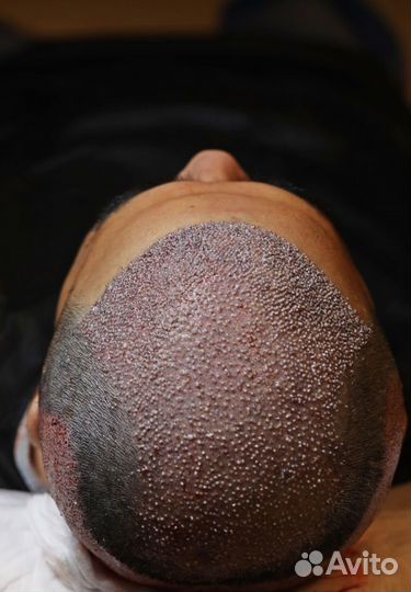 Пересадка волос в Казани