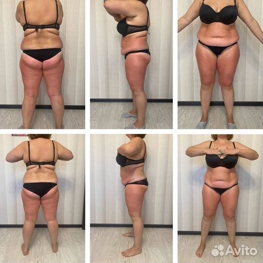 Антицеллюлитный массаж