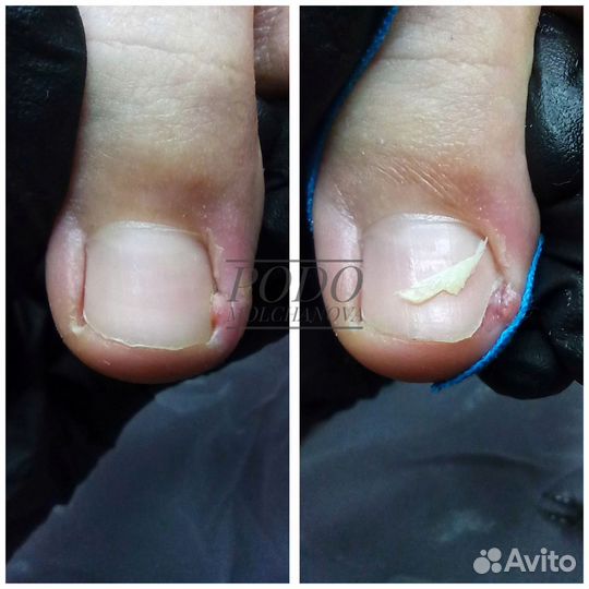 Подолог. Работа с проблемами стопы. Вросший ноготь