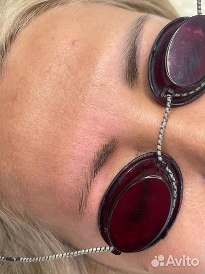 Обучение удаление татуажа лазером