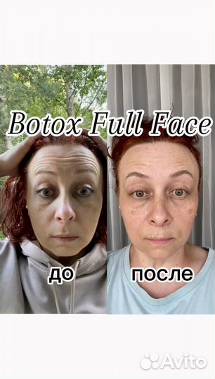 Ботокс Full Face