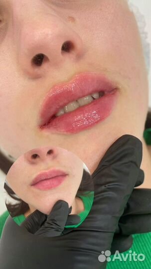 Увелечение губ;Ботулинотерапия