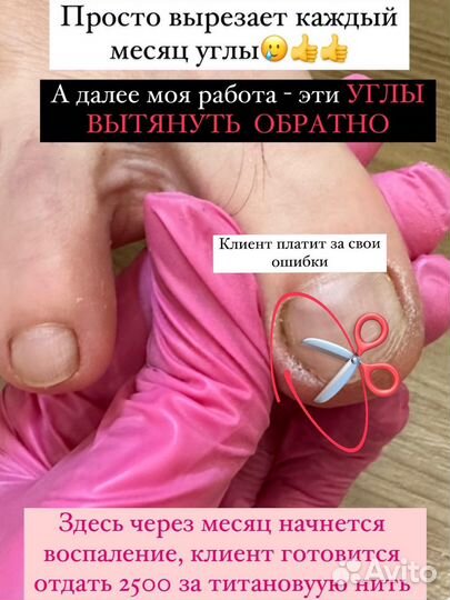 Педикюр медицинский подолог