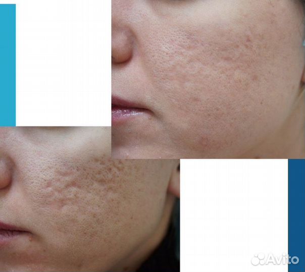 Удаление шрамов и рубцов