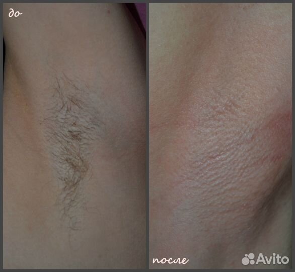 Депиляция воском, шугаринг