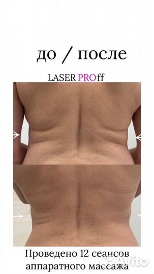 Антицеллюлитный аппаратный массаж