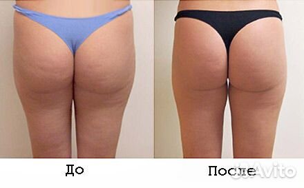 Lpg массаж / Кавитация / RF лифтинг