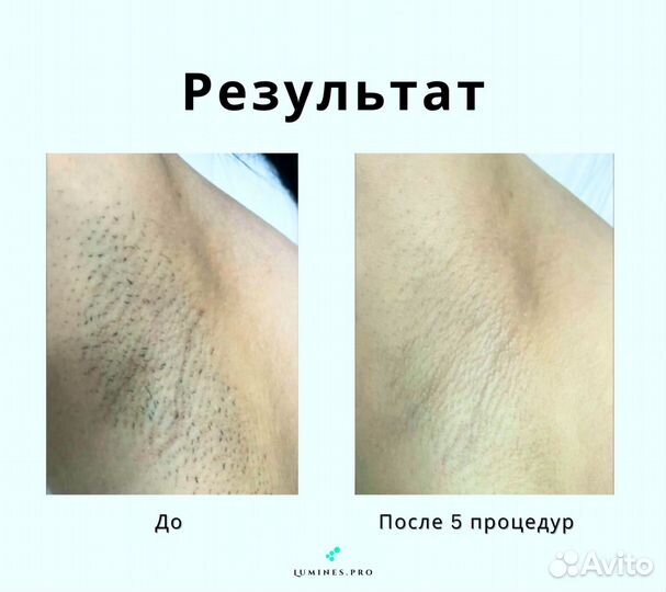 Аппарат для эпиляции Люминес’ Макс-Ван 1200W