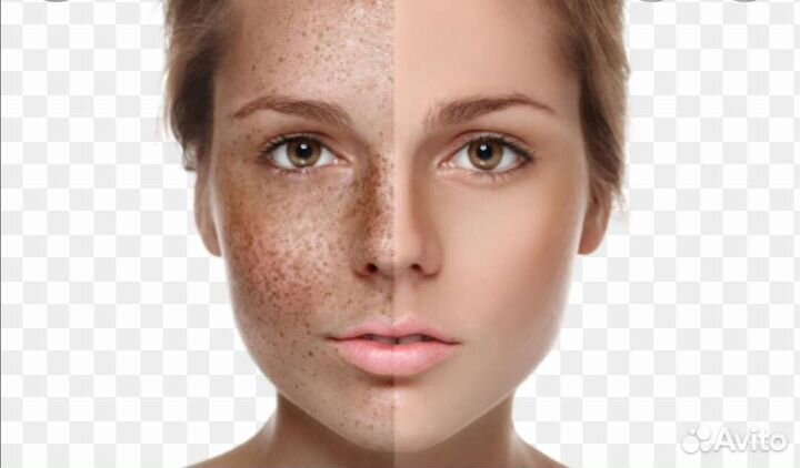 Лазерная эпиляция