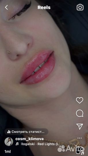 Контурная пластика губ