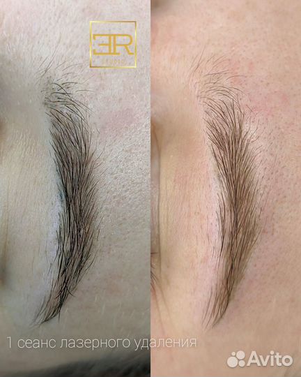 «Лазерное удаление Тату / Татуажа, пм»