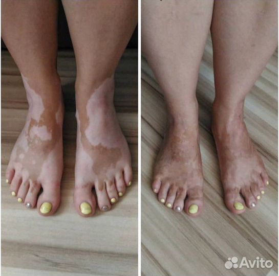 Лосьон - автозагар маскирует витилиго