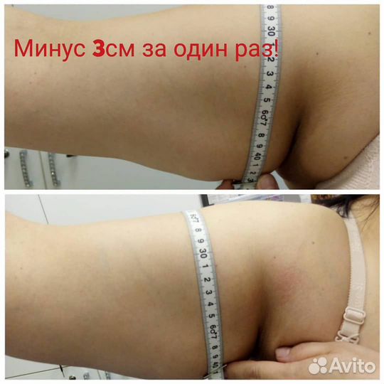 Похудение. Безоперационная липосакция. Целлюлит