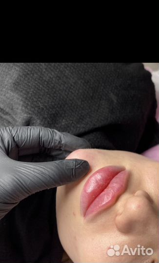 Контурная пластика губ,увеличение губ