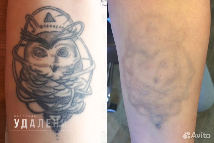 Лазерное удаление тату