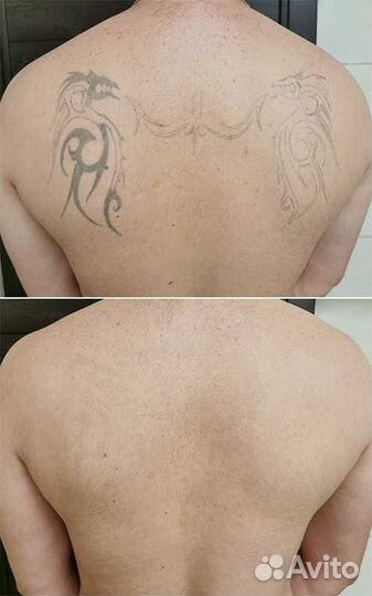 Лазерное Удаление тату и татуажа