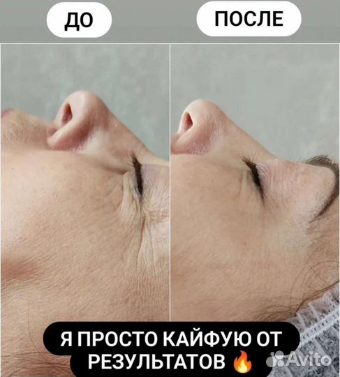 Моделирование лица (лифтинг) и зоны декольте