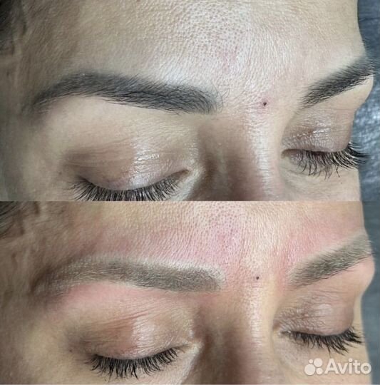 Удаление татуажа и тату