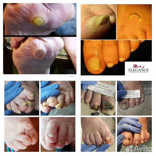 Педикюр для пожилых. Обучение силелок