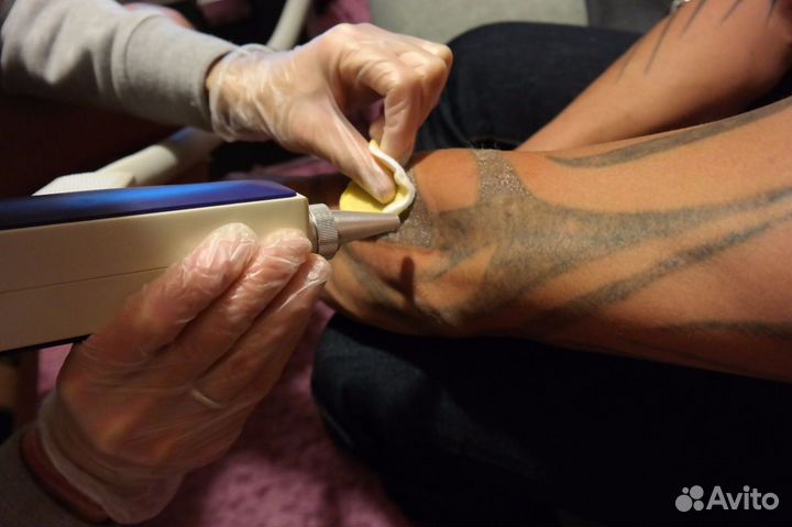 Удаление тату и татуажа